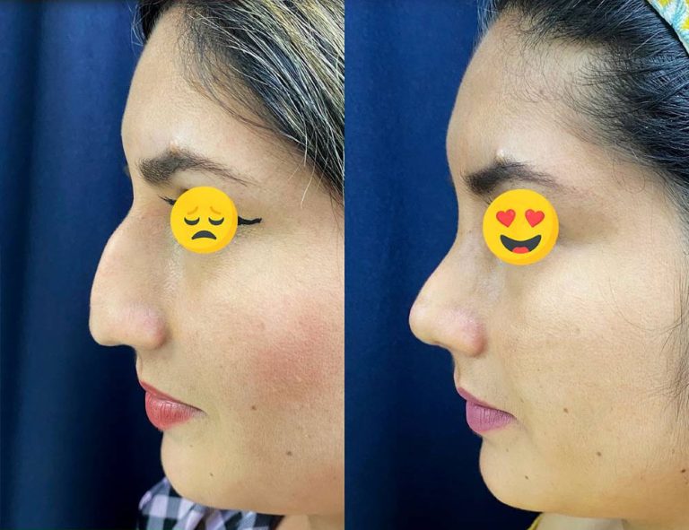 Rinoplastia (40 días)