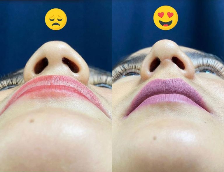 Rinoplastia (40 días)