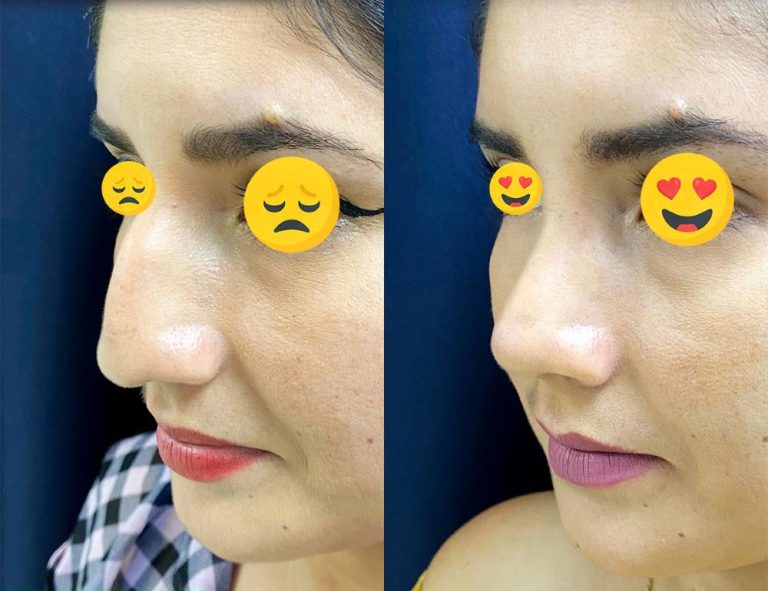 Rinoplastia (40 días)
