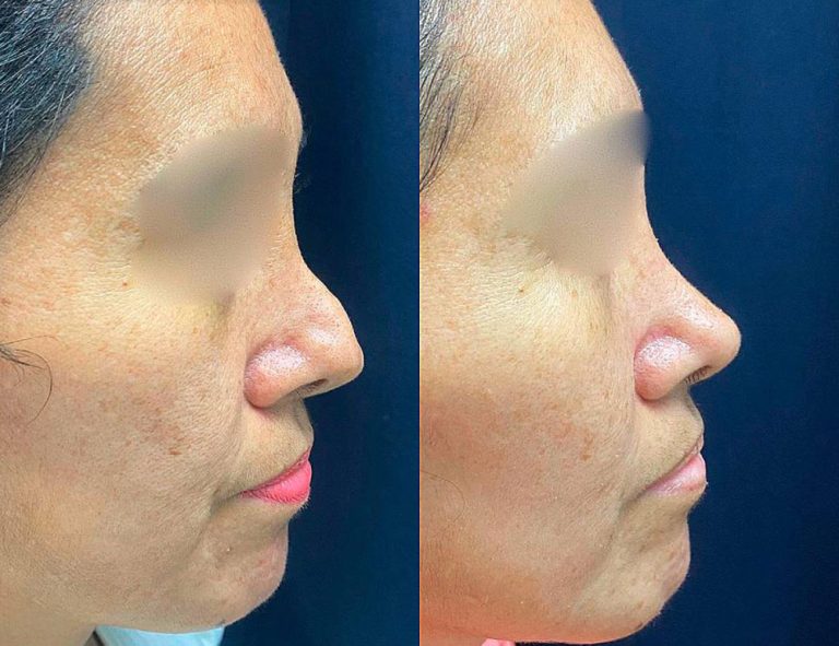 Rinoplastia Secundaria