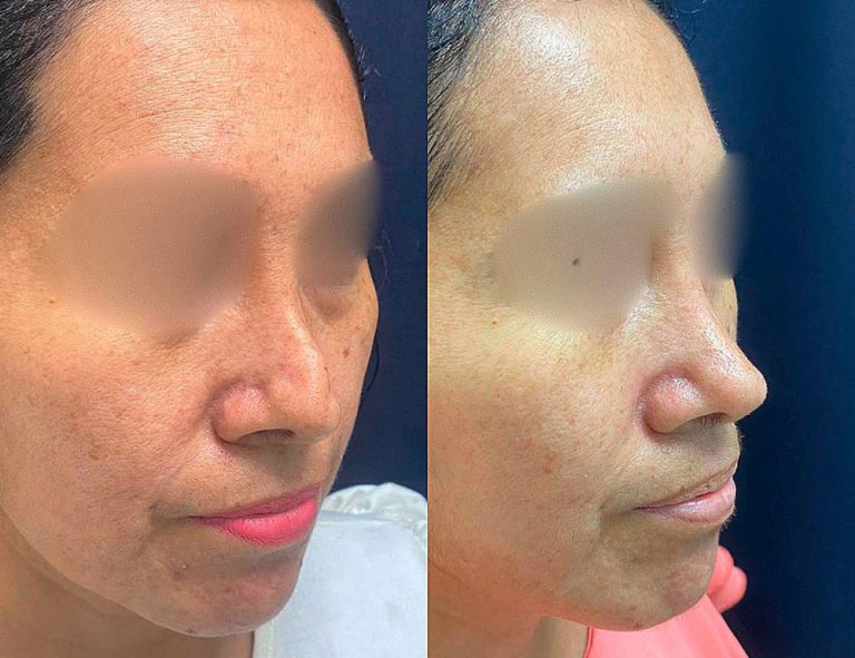 Rinoplastia Secundaria