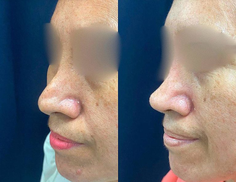 Rinoplastia Secundaria