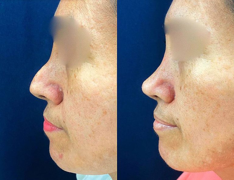 Rinoplastia Secundaria