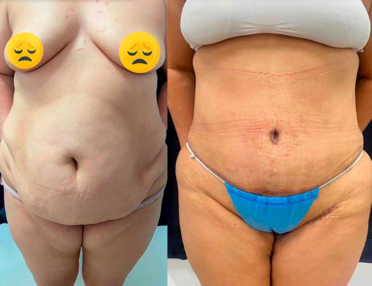 Lipoabdominoplastia (40 días)