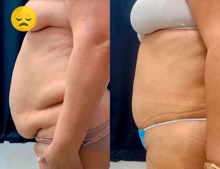 Lipoabdominoplastia (40 días)