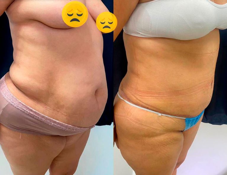 Lipoabdominoplastia (40 días)