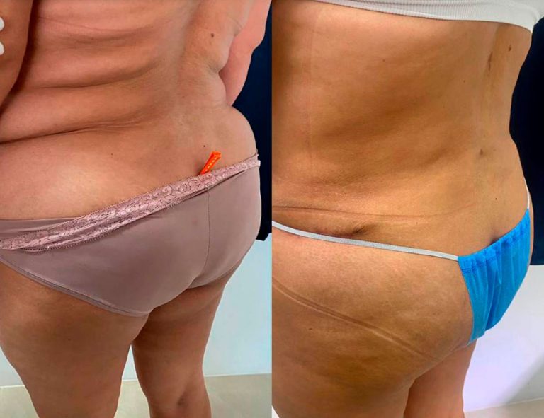 Lipoabdominoplastia (40 días)