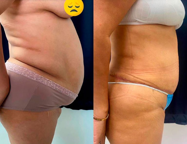 Lipoabdominoplastia (40 días)