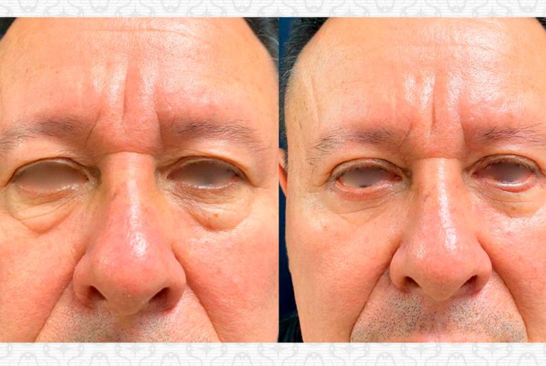 Blefaroplastia. Post-operatorio (3 meses)