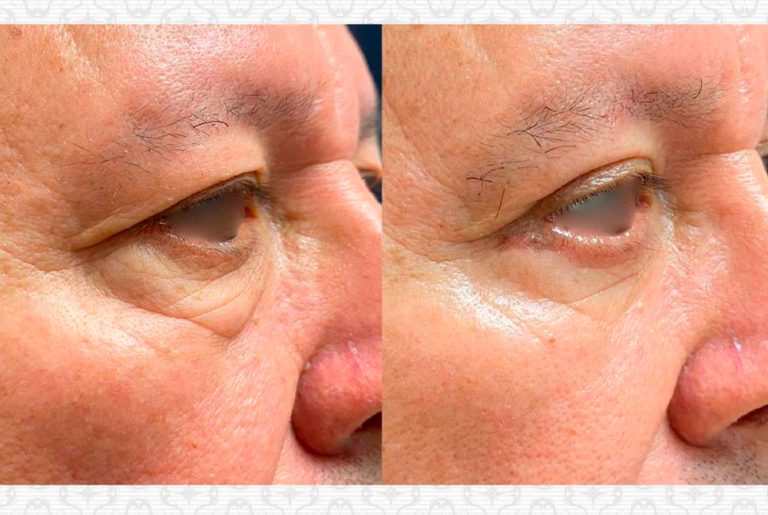 Blefaroplastia. Post-operatorio (3 meses)
