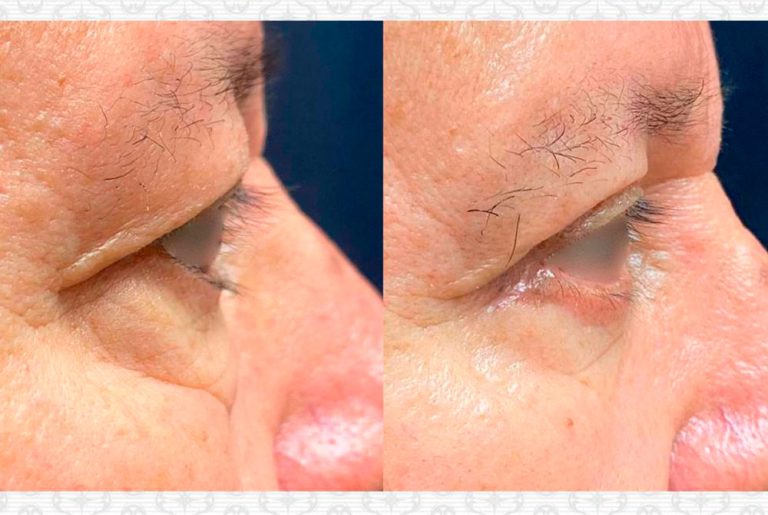 Blefaroplastia. Post-operatorio (3 meses)