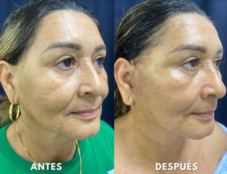 Rejuvenecimiento cérvico facial (14 días post operatorio)