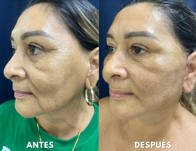 Rejuvenecimiento cérvico facial (14 días post operatorio)