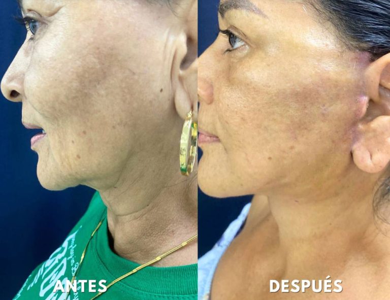Rejuvenecimiento cérvico facial (14 días post operatorio)