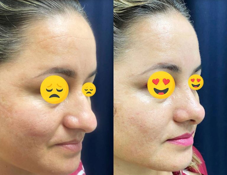 Rinoplastia (40 días)