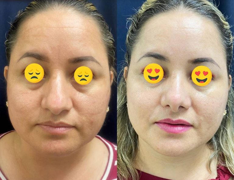 Rinoplastia (40 días)