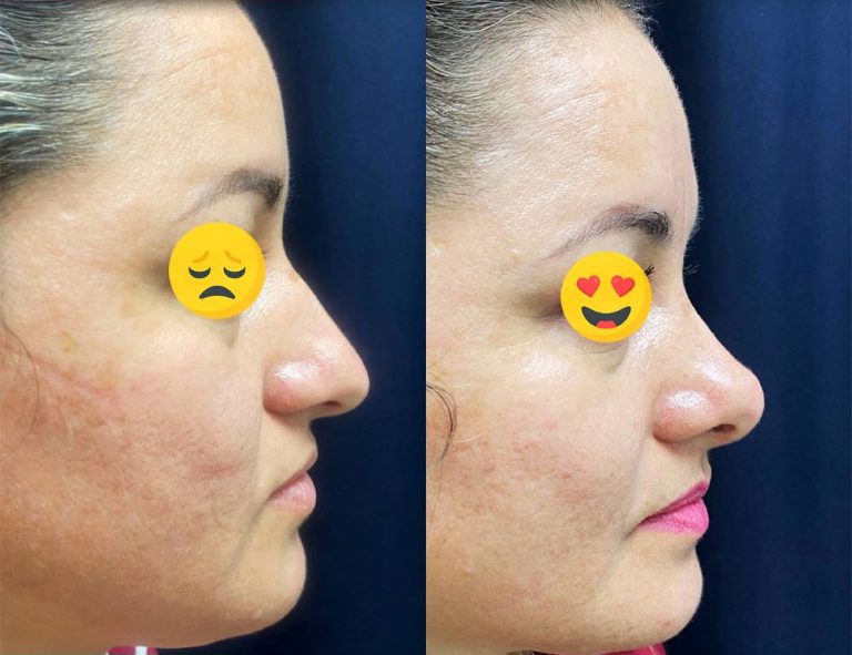 Rinoplastia (40 días)