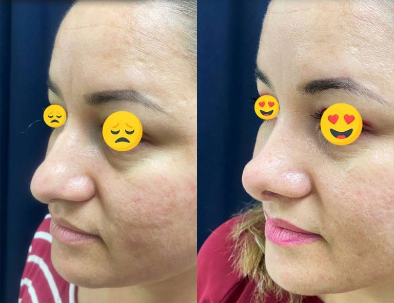 Rinoplastia (40 días)