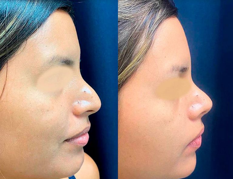 Rinoplastia Secundaria