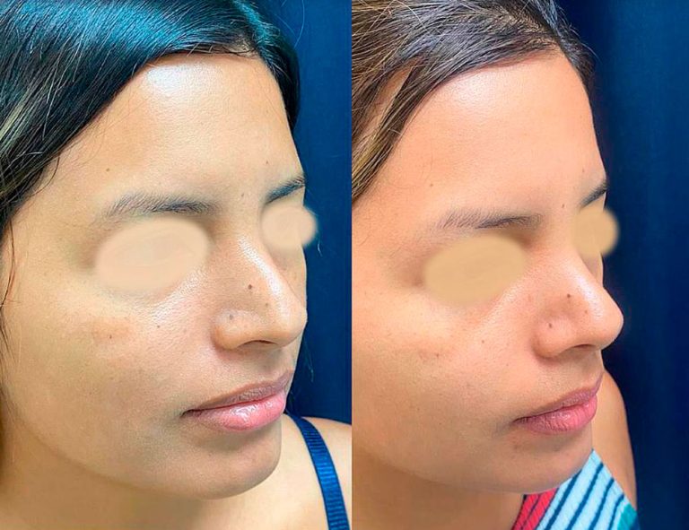 Rinoplastia Secundaria