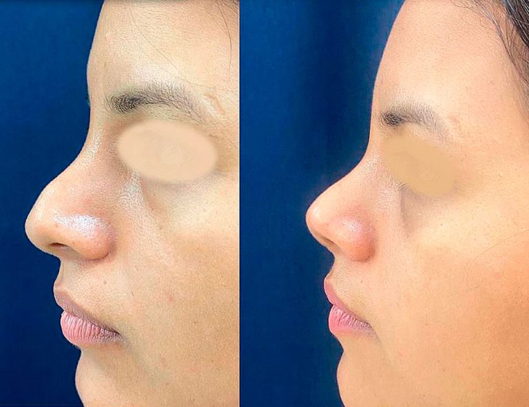 Rinoplastia Secundaria