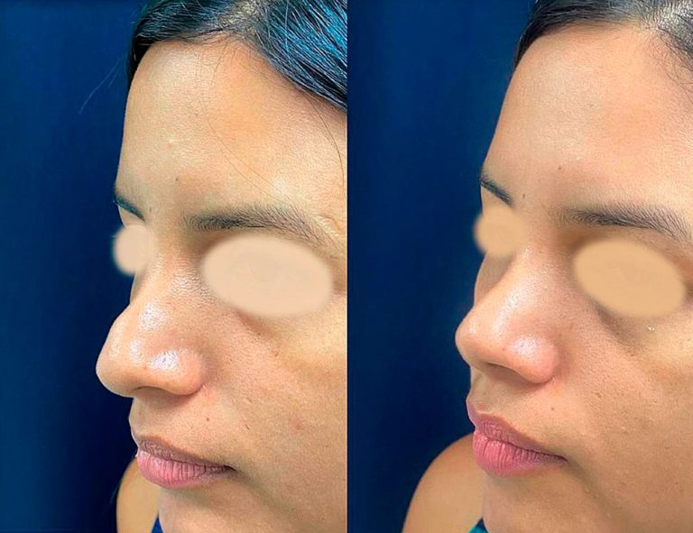 Rinoplastia Secundaria