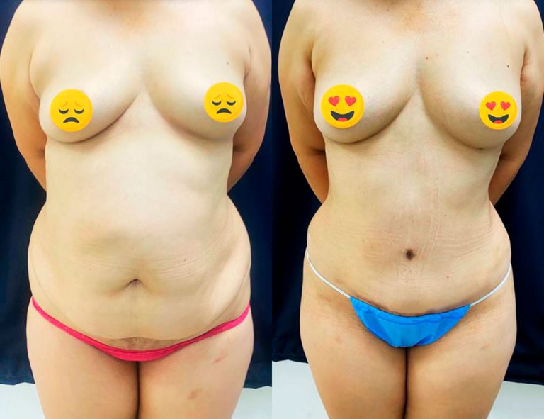 Abdominoplastia (2 meses)