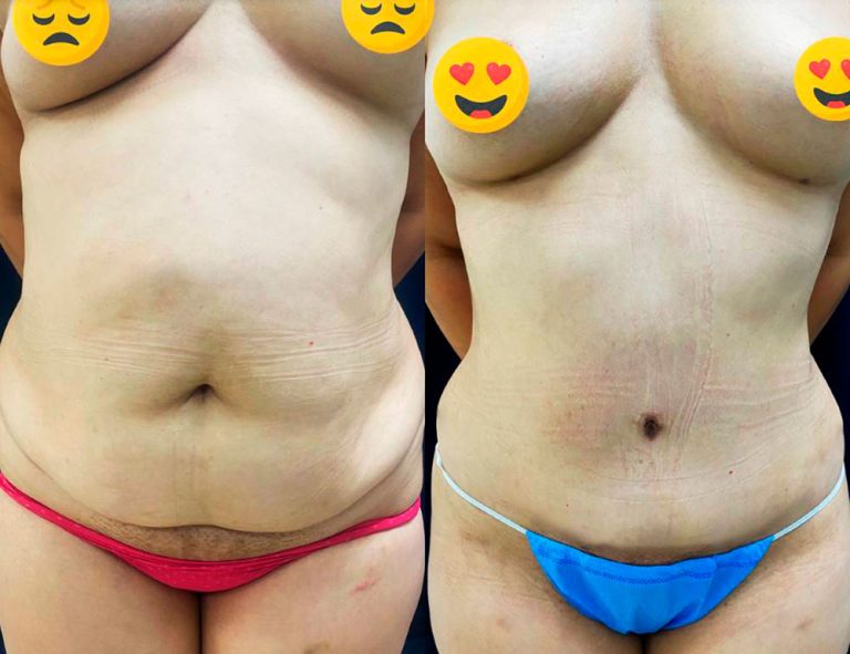 Abdominoplastia (2 meses)