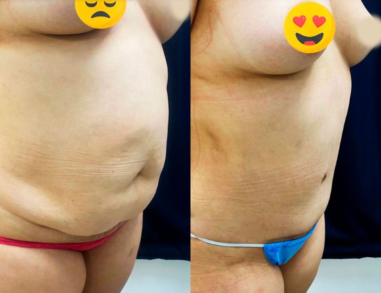 Abdominoplastia (2 meses)