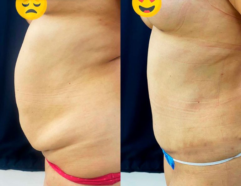 Abdominoplastia (2 meses)