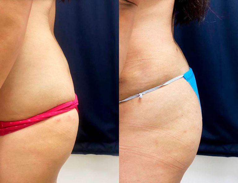 Abdominoplastia (2 meses)