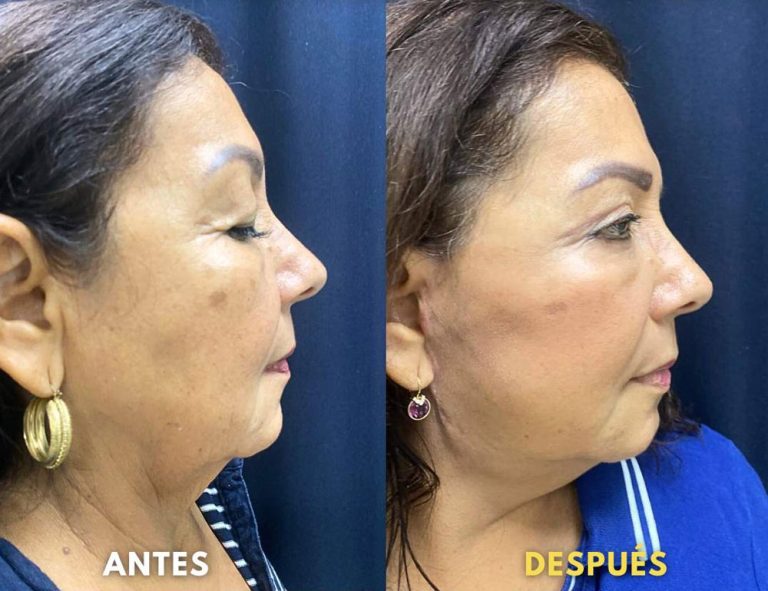 Rejuvenecimiento cérvico facial (40 días post operatorio)