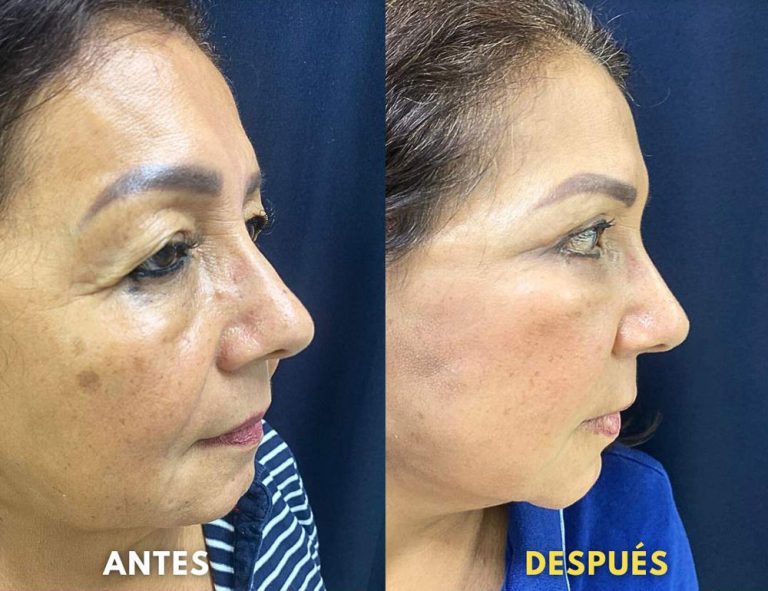 Rejuvenecimiento cérvico facial (40 días post operatorio)