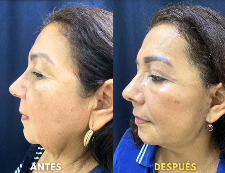 Rejuvenecimiento cérvico facial (40 días post operatorio)