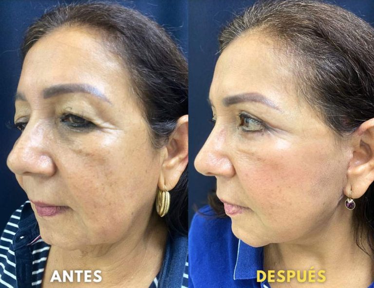 Rejuvenecimiento cérvico facial (40 días post operatorio)