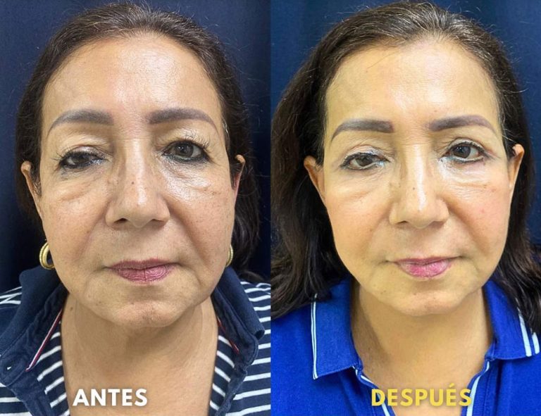 Rejuvenecimiento cérvico facial (40 días post operatorio)