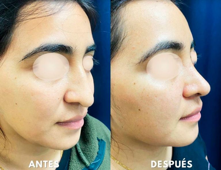 Post-operatorio (2 meses)