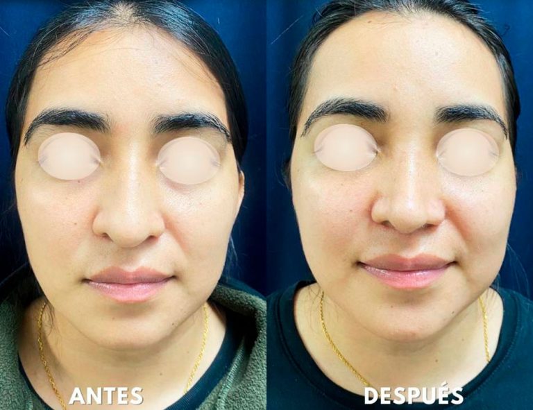 Post-operatorio (2 meses)