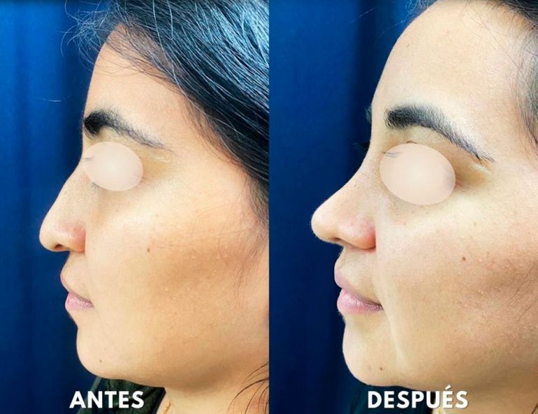 Post-operatorio (2 meses)