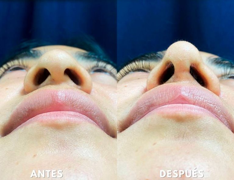 Post-operatorio (2 meses)