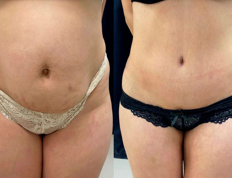 Abdominoplastia (3 meses)