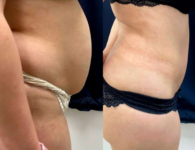 Abdominoplastia (3 meses)