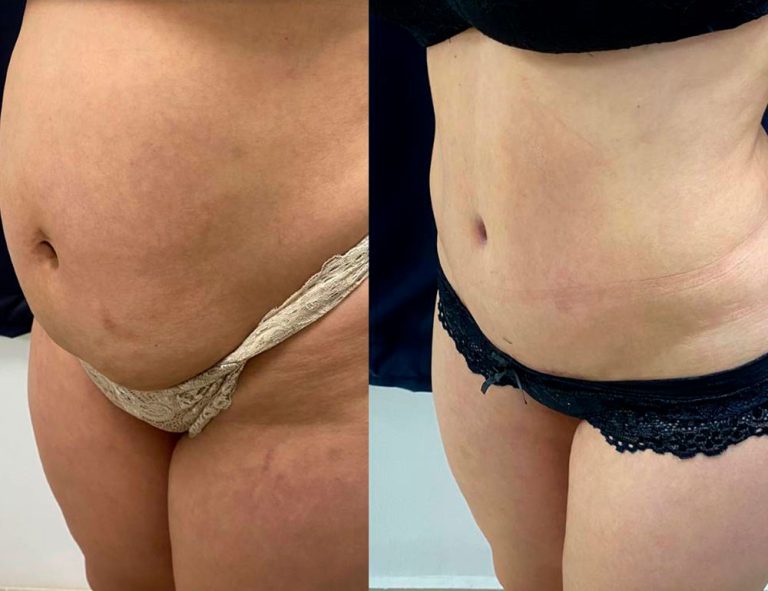 Abdominoplastia (3 meses)