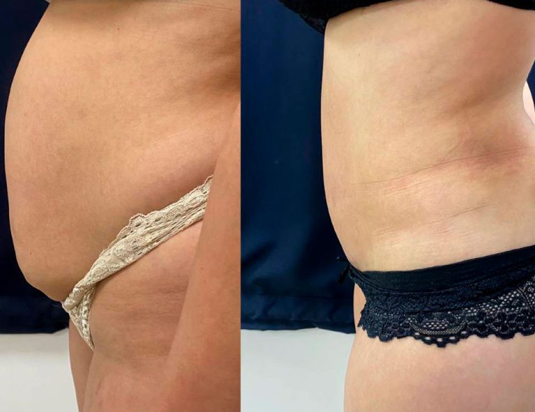 Abdominoplastia (3 meses)