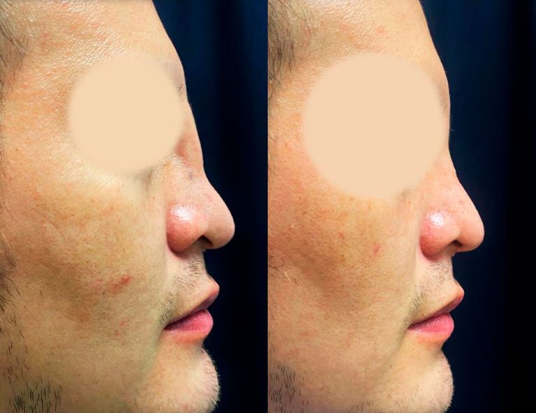 Rinoplastia (2 meses)