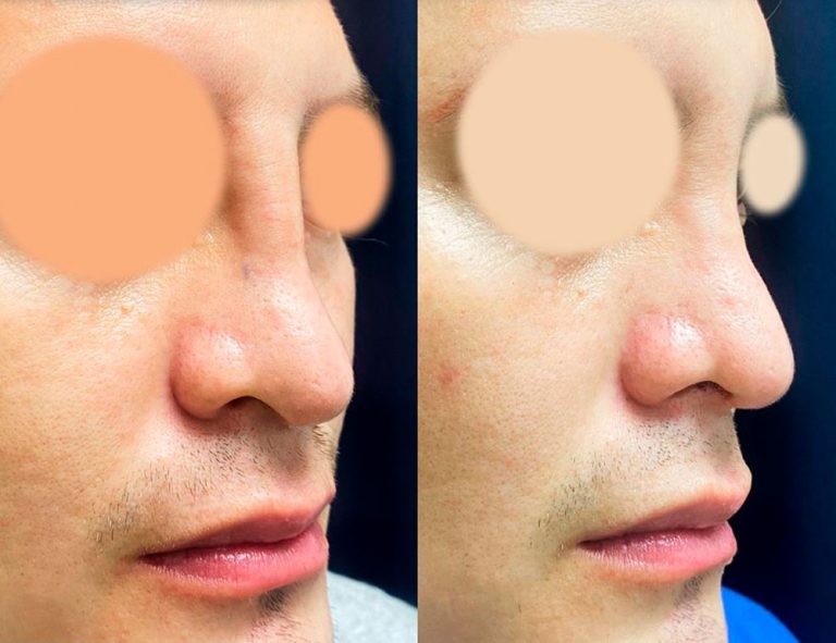 Rinoplastia (2 meses)