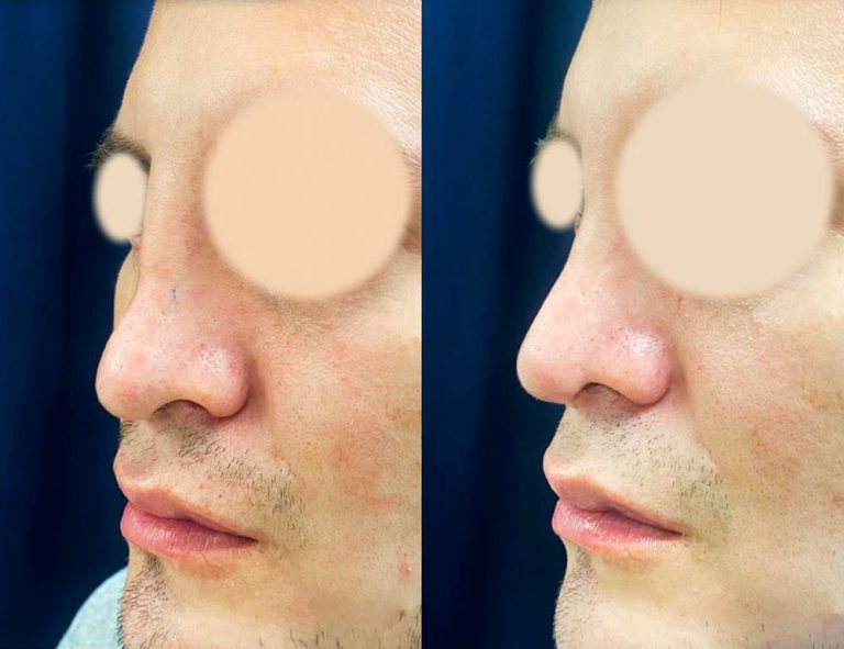 Rinoplastia (2 meses)