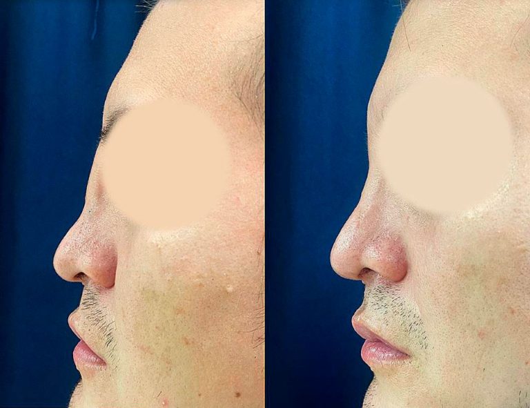 Rinoplastia (2 meses)