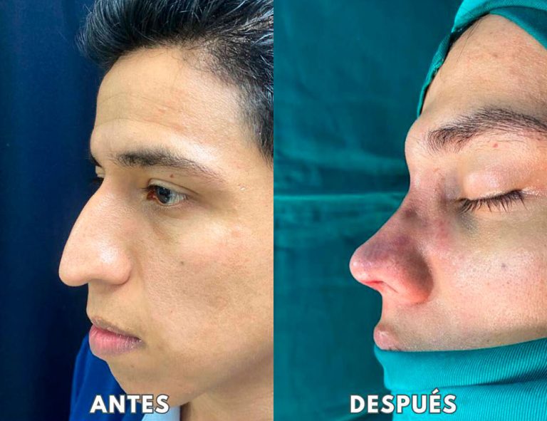 Post-operatorio inmediato