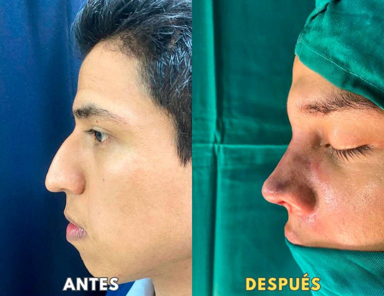 Post-operatorio inmediato